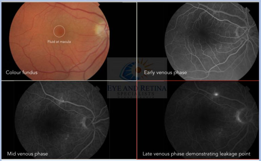 Four-panel fluorescein angiography montage showing Central Serous Retinopathy with a colour fundus photograph