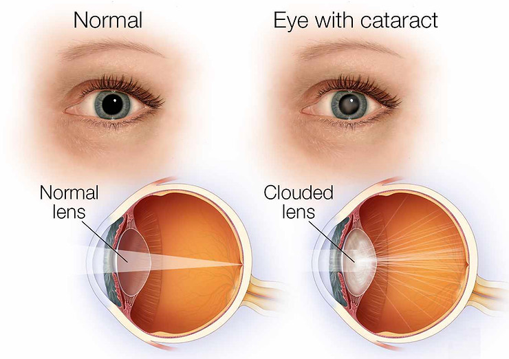 An eye with a normal lens compared to an eye with a cataract which is a cloudy lens