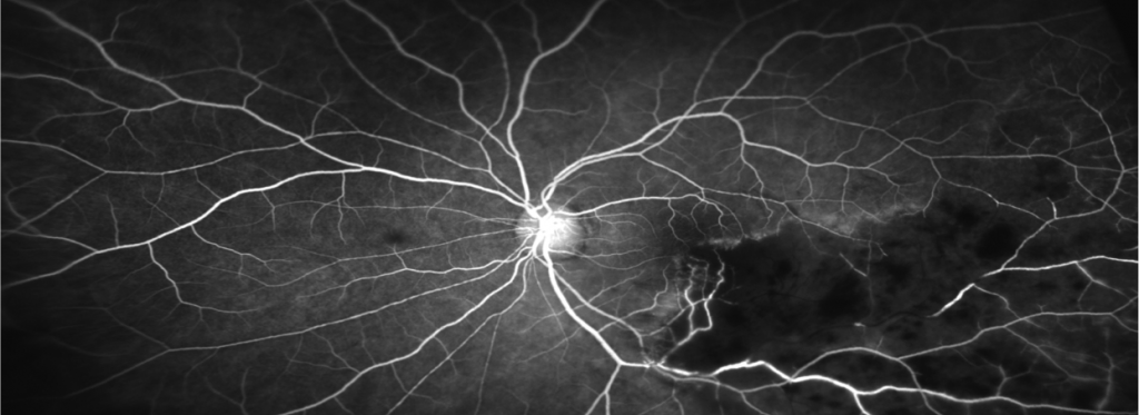 Fundus Fluorescein Angiogram FFA showing retinal blood flow changes and ischaemic retina