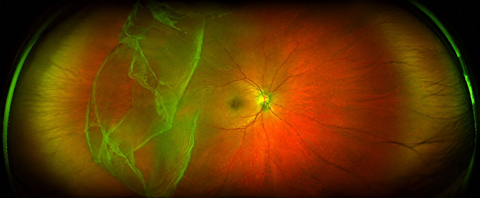 Ultra widefield retinal image showing a temporal bullous rhegmatogenous retinal detachment