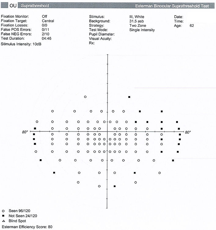 Binocular Esterman visual field for dirving licence testing sydney