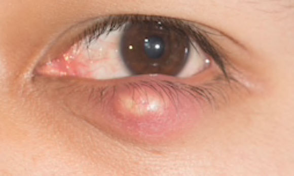 Lower eyelid chalazion that will require chalazion surgery in Sydney