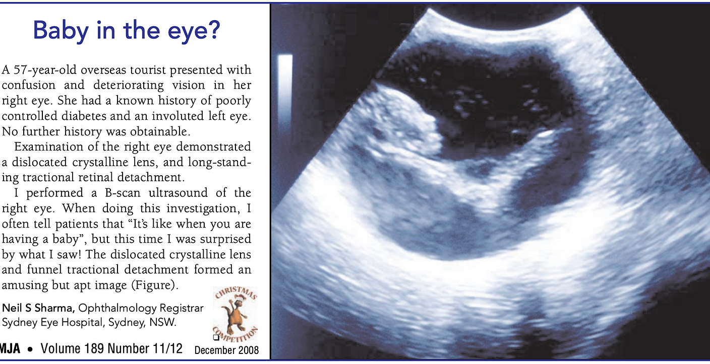 Ophthalmic ultrasound image published in the Medical Journal of Australia (MJA) demonstrating chronic funnel retinal detachment and dislocated crystalline lens