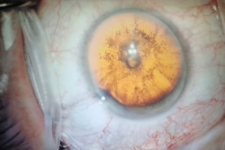 Sydney ophthalmologist performing cataract surgery - view from operating microscope.jpg