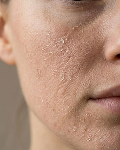 dry-skin.jpg