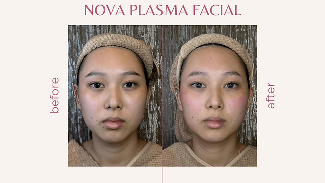 Before and after Nova Plasma Facial showing visibly firmer, smoother, and more supple skin on a woman’s full face at Beauty Full Skin Wellness Singapore.