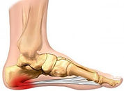 Plantar Fasciitis