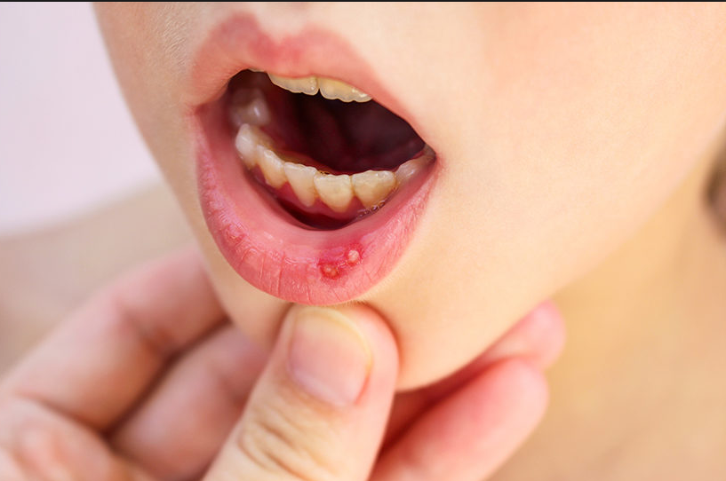 Chicago Dentist Ow! Your Guide to Canker Sores