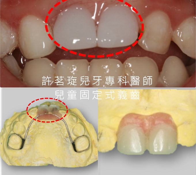 wix-兒童固定式義齒.jpg