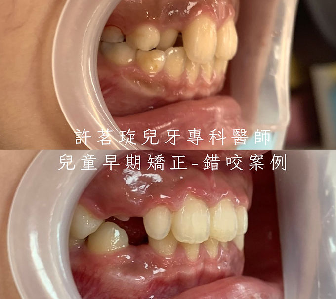 許茗琁兒牙專科醫師錯咬-胡○榕.jpg