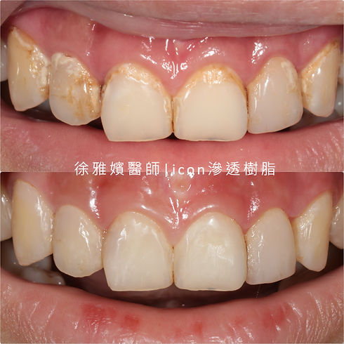 icon icon滲透樹脂 矯正牙齒脫鈣治療 門牙脫鈣台北 台北