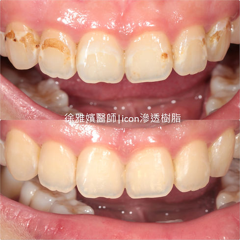 icon icon滲透樹脂 矯正牙齒脫鈣治療 門牙脫鈣台北 台北