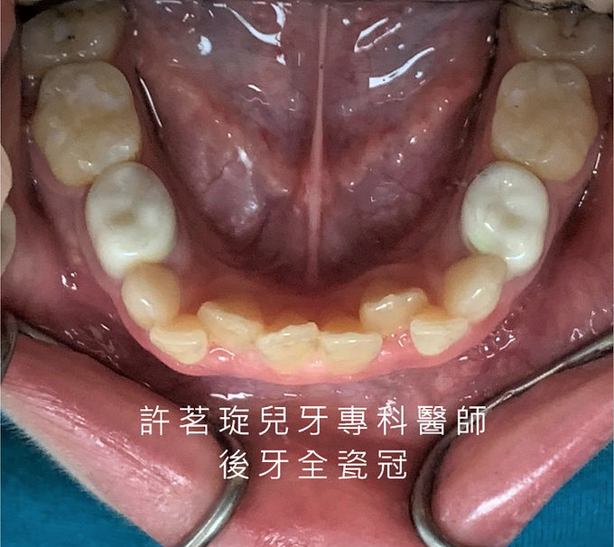 wix-後牙乳牙全瓷冠.jpg