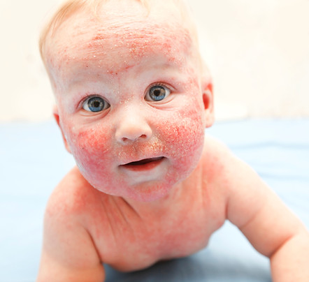 Baby with Severe Eczema