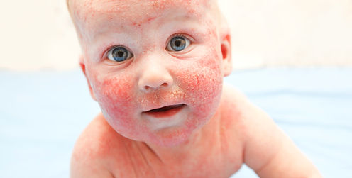 baby with eczema