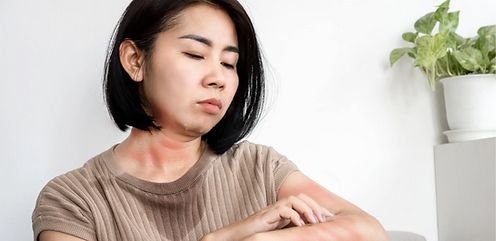 woman with eczema