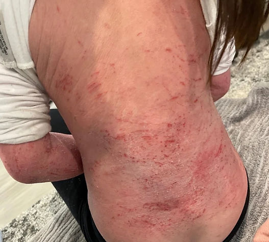 A person with a rash on their back