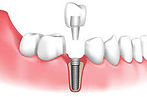 tooth implant.jpg