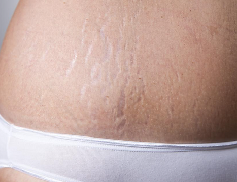 Stretch Marks Firming Treatment