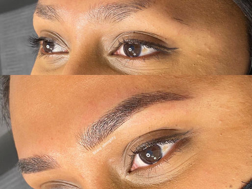 PMU for Traction Alopecia: Restoring Confidence One Brow at a Time