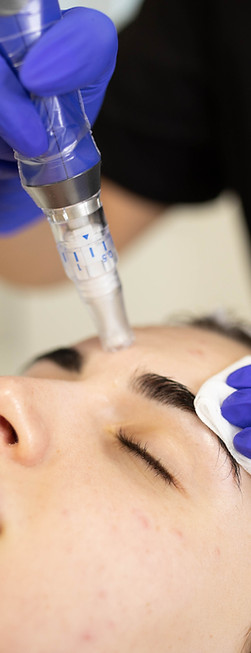 NEedling.JPG