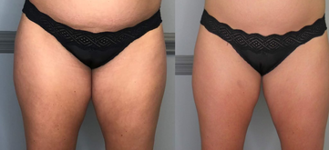 Sculpt Body Contouring & Wellness Before and after results