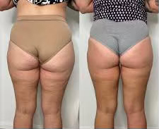 Sculpt Body Contouring & Wellness Before and after results