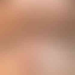 Carbonpeeling-berlin