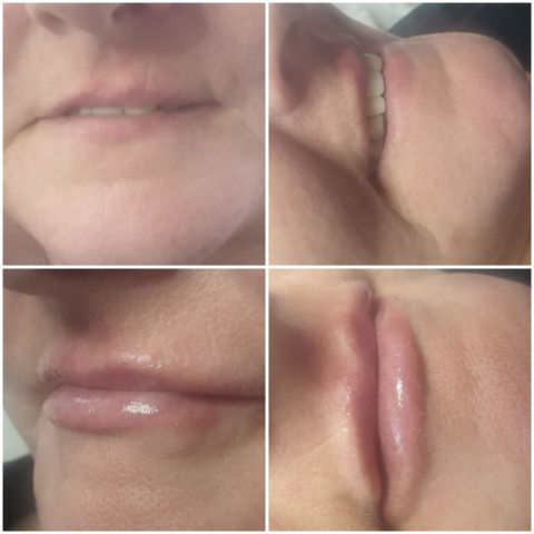 A collage of images showcasing before and after lip fillers