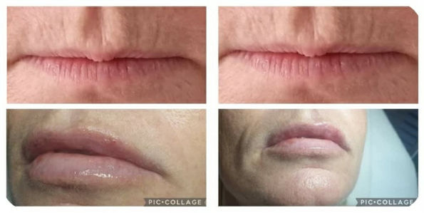 Images showcasing lips before and after lip fillers and beauty treatments