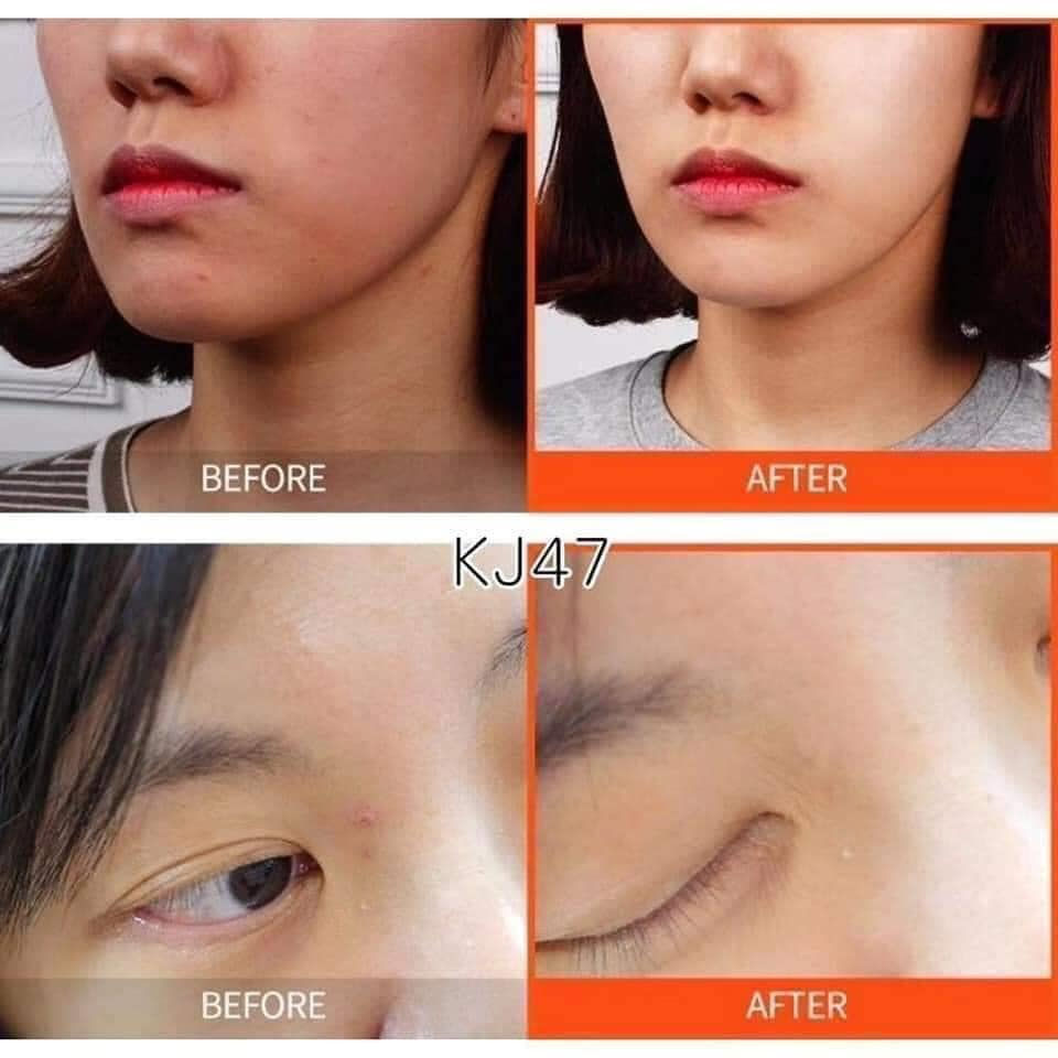 縮圖：The Yeon 痘痘液