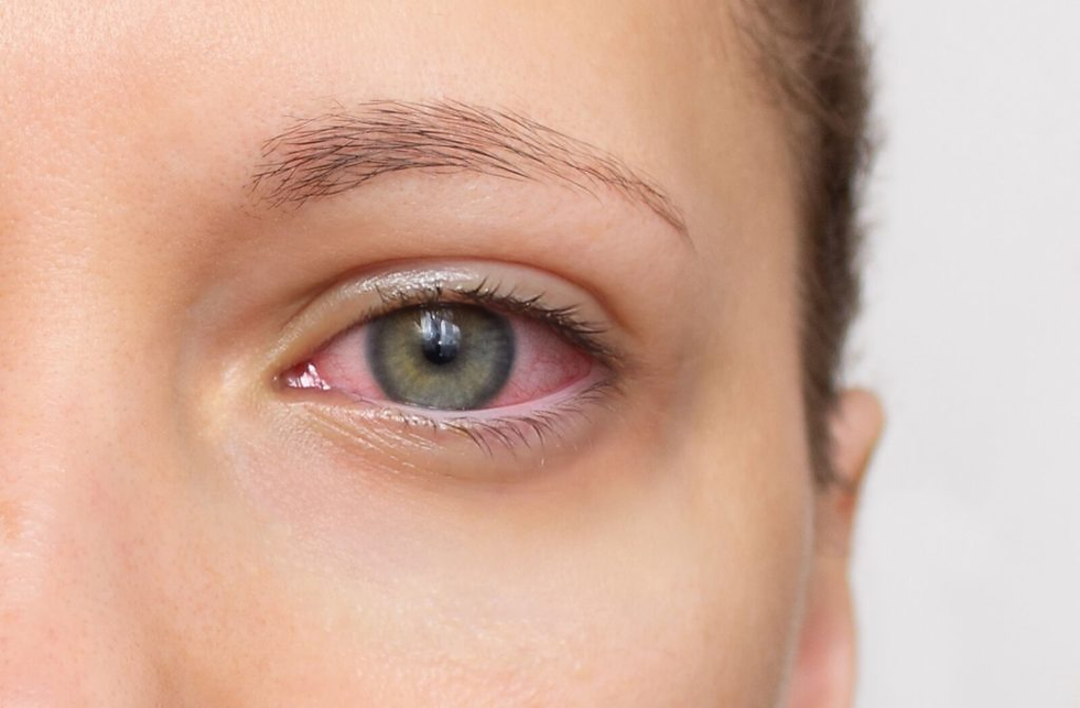 why do eyes become dry while wearing contact lenses 