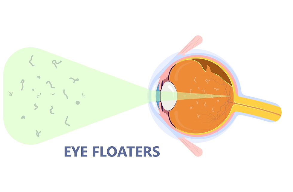 Is eye Floaters Dangerous