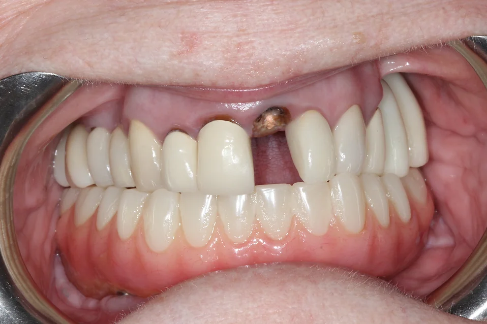 Missing Tooth