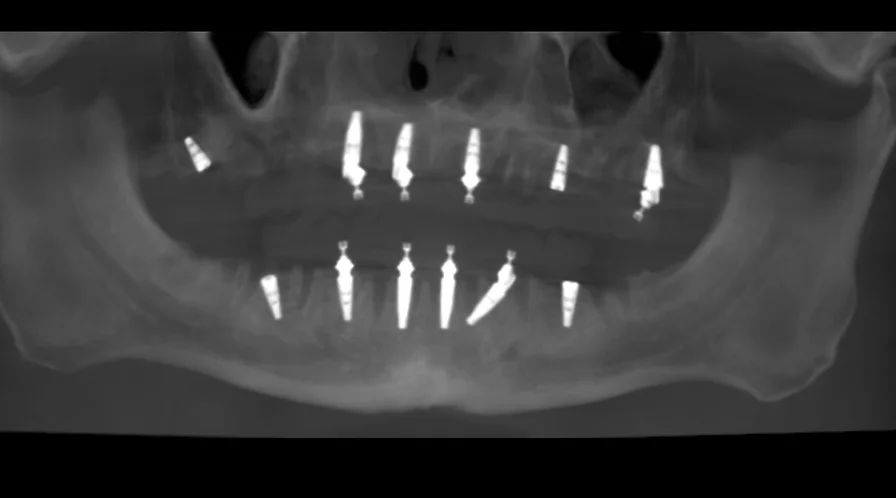 Clayton Implants.webp