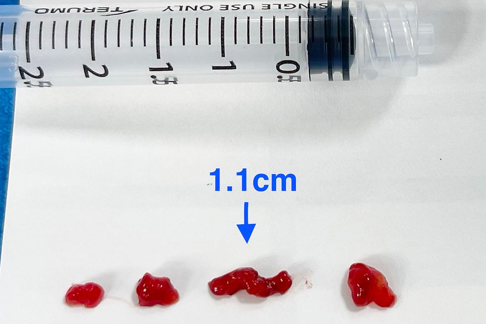 14歲孩子心臟藏7公分「炸彈」 10分鐘緊急完成顱內取栓救回大腦
