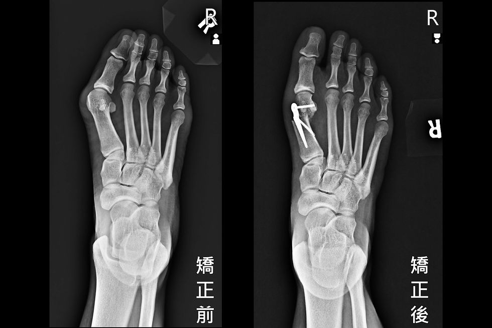 術前X光可見腳趾重疊,經過力學重建矯正,術後第一與第二腳趾骨已分開。