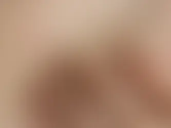 Shingles (Herpes Zoster)