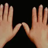 Scleroderma Treatment