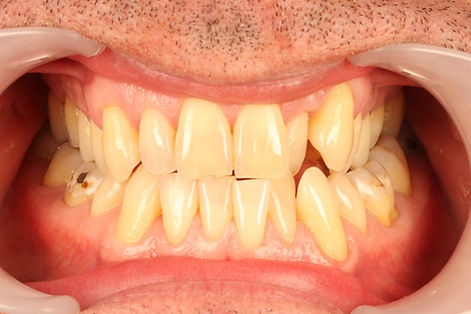 Smilelign, Teeth Straightening, Oakbank Dental, Perth