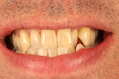Smilelign, Teeth Straightening, Oakbank Dental, Perth