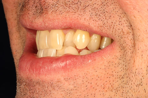 Smilelign, Teeth Straightening, Oakbank Dental, Perth