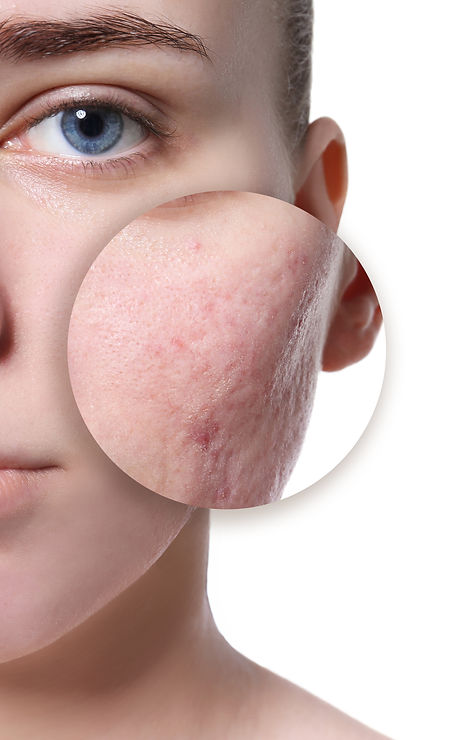 Young woman before and after acne treatm