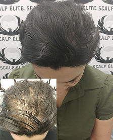 female scalp camouflage