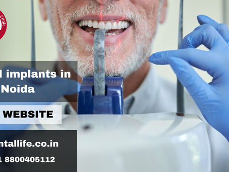 Dental Implants In Noida: Restore Your Smile With Dental Life