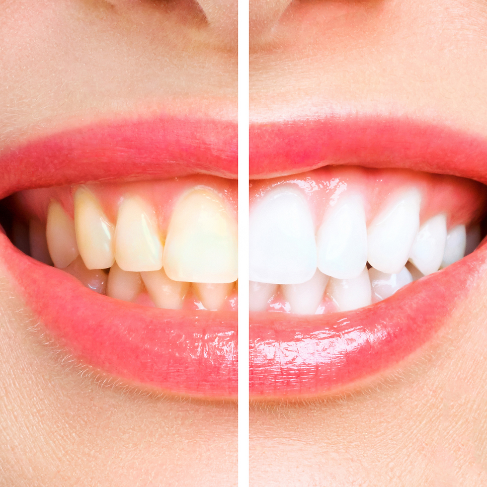 teeth whitening Atasehir