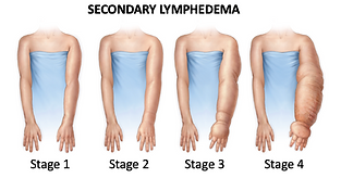 Secondary Lymphedema