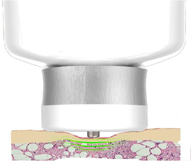 SkinFibroMeter™ device applying pressure on tissue sample, with a cross-section showing pink and beige cellular structures. White background.