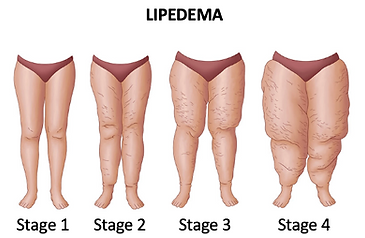 Lipedema