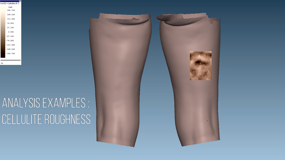 Cellulite roughness capture and analysis
